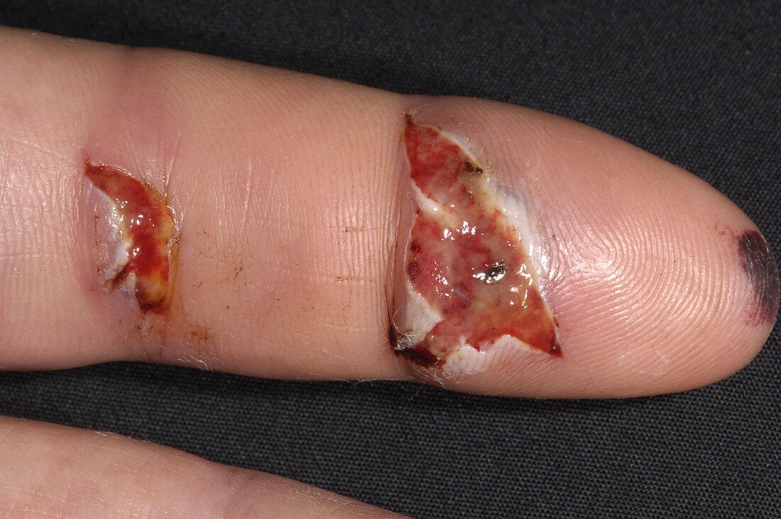 Finger injury