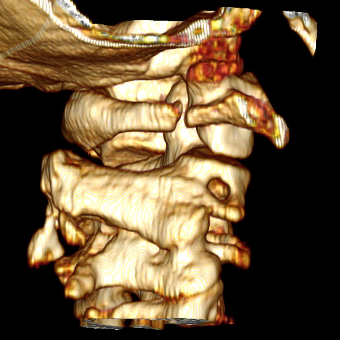 Fractured atlas vertebra,3D CT scan