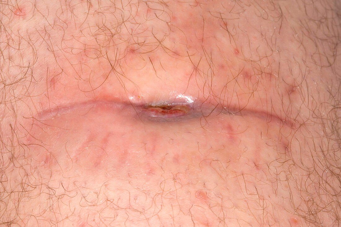 Infected cut on leg