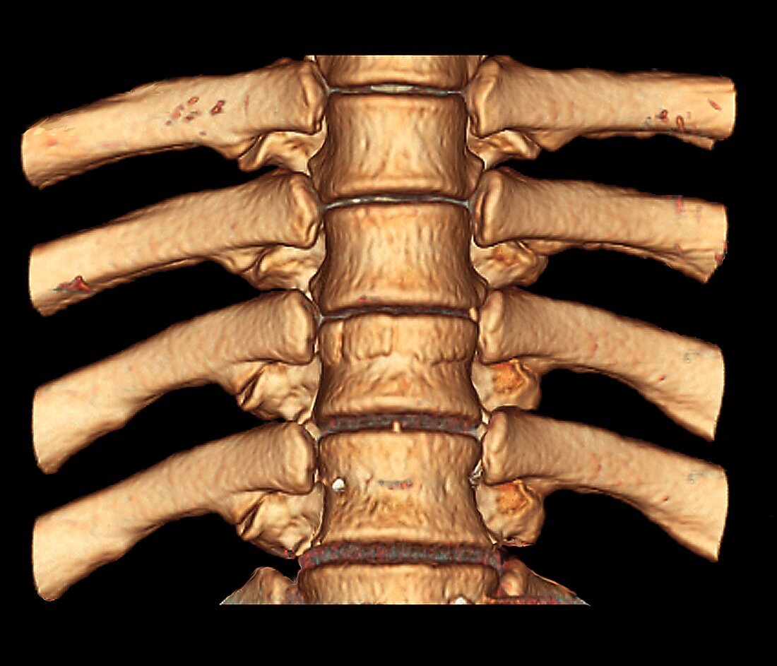 Fractured spine,3D CT scan