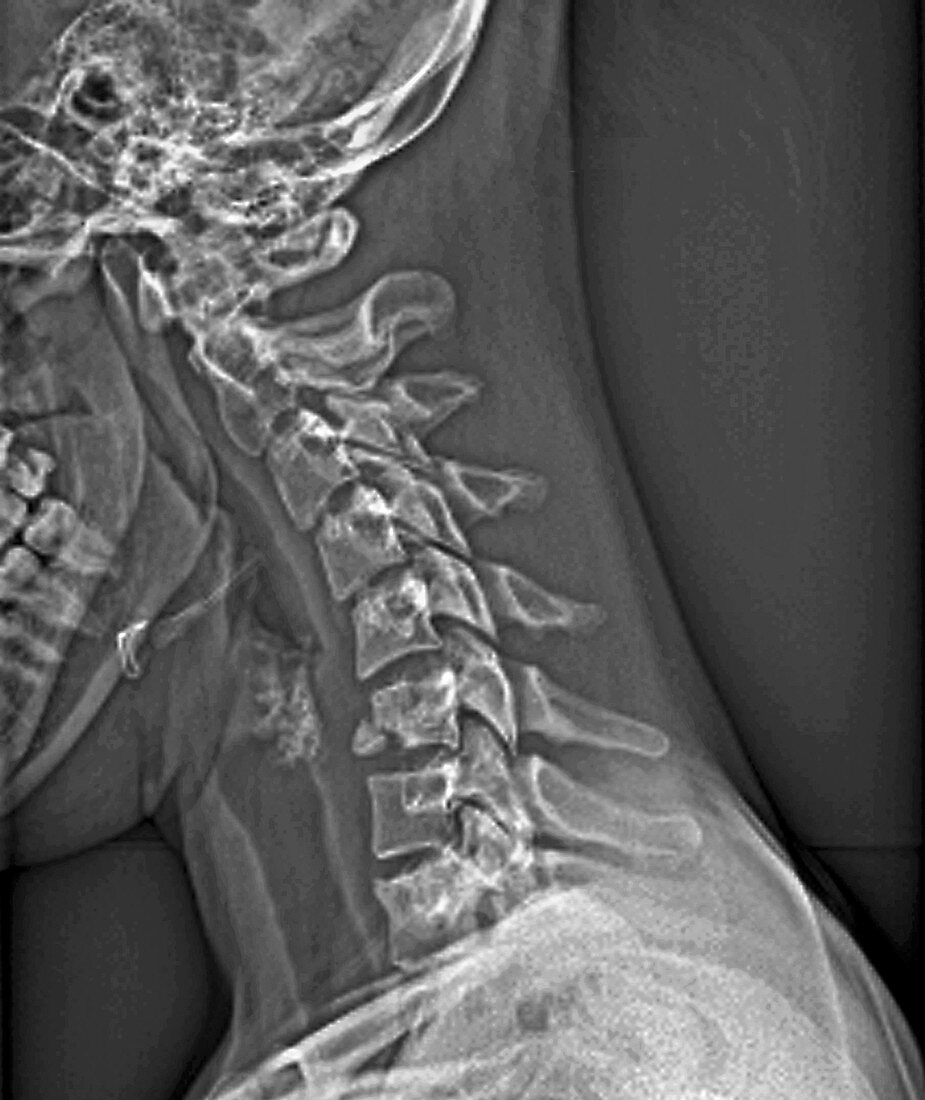 Fractured neck,X-ray