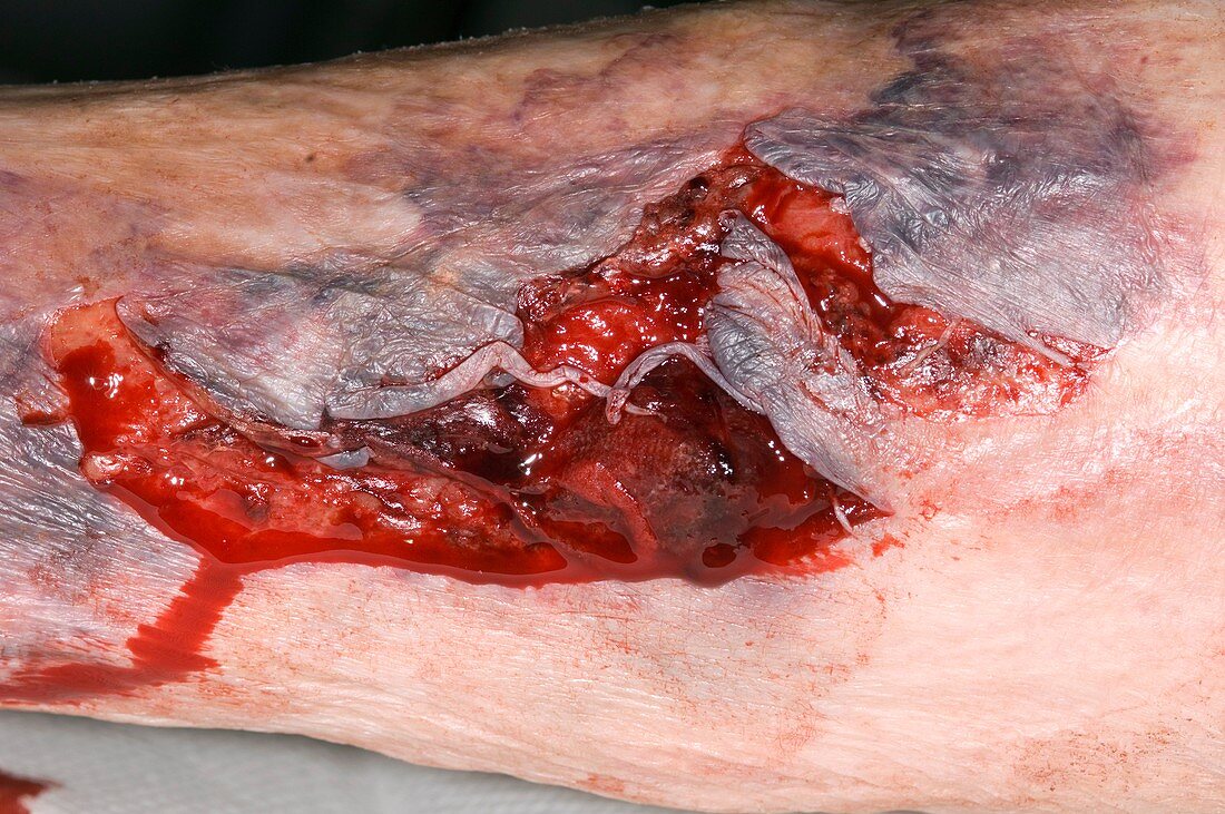 Lacerated leg