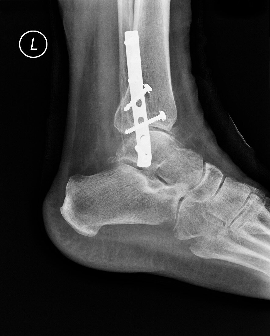 Pinned ankle fracture,X-ray