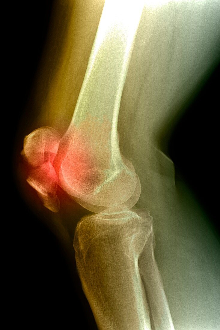 Kneecap fracture,X-ray