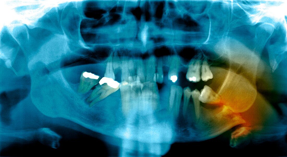 Fractured jawbone,X-ray