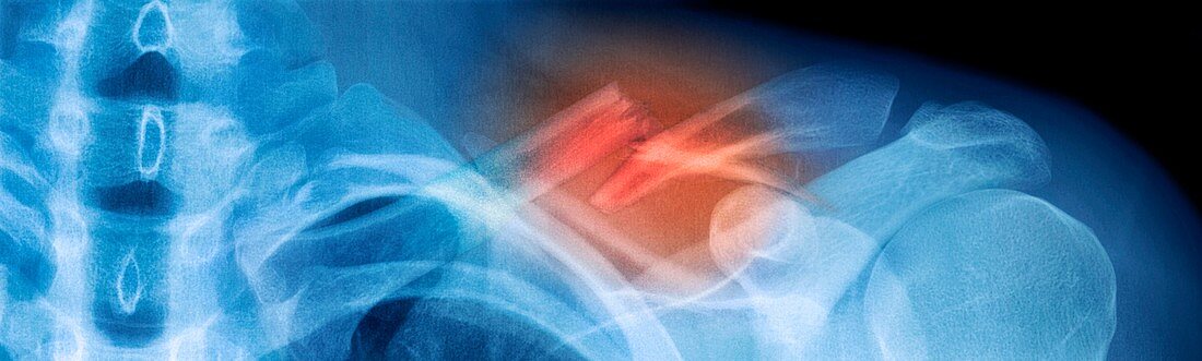 Fractured collar bone,X-ray