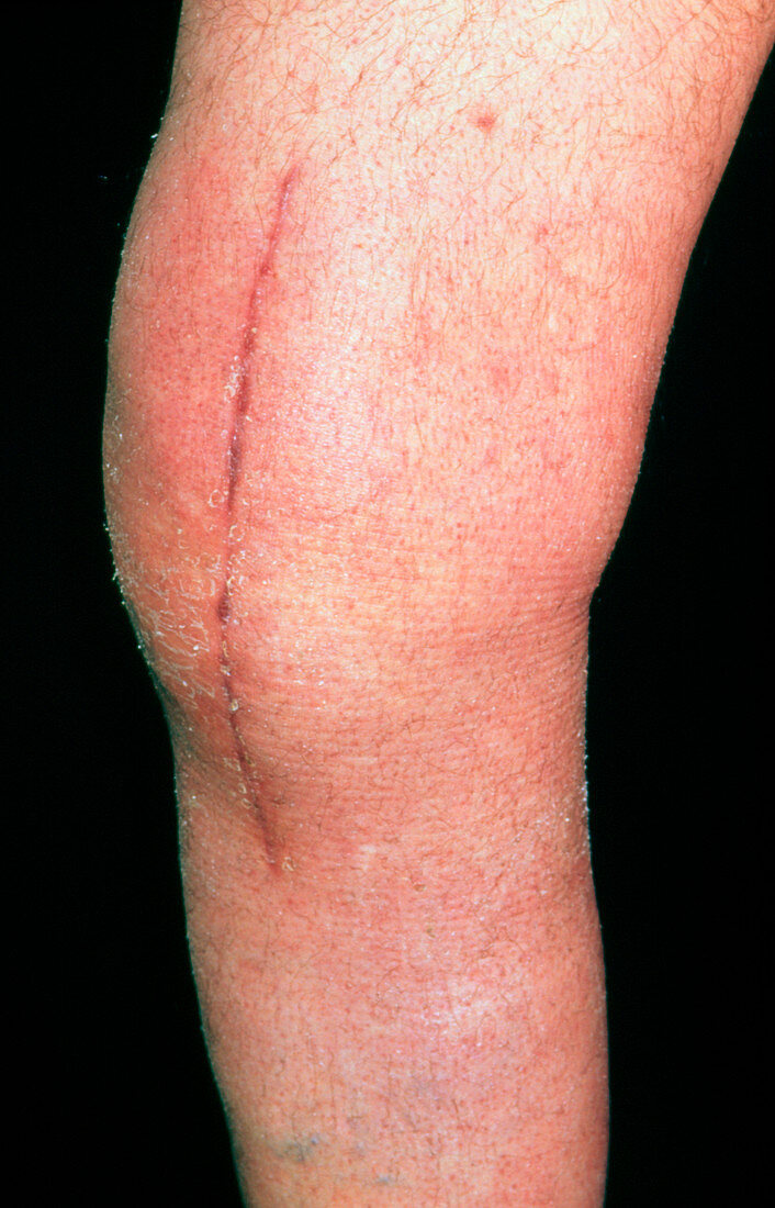 Post-operative scar: knee of elderly male patient