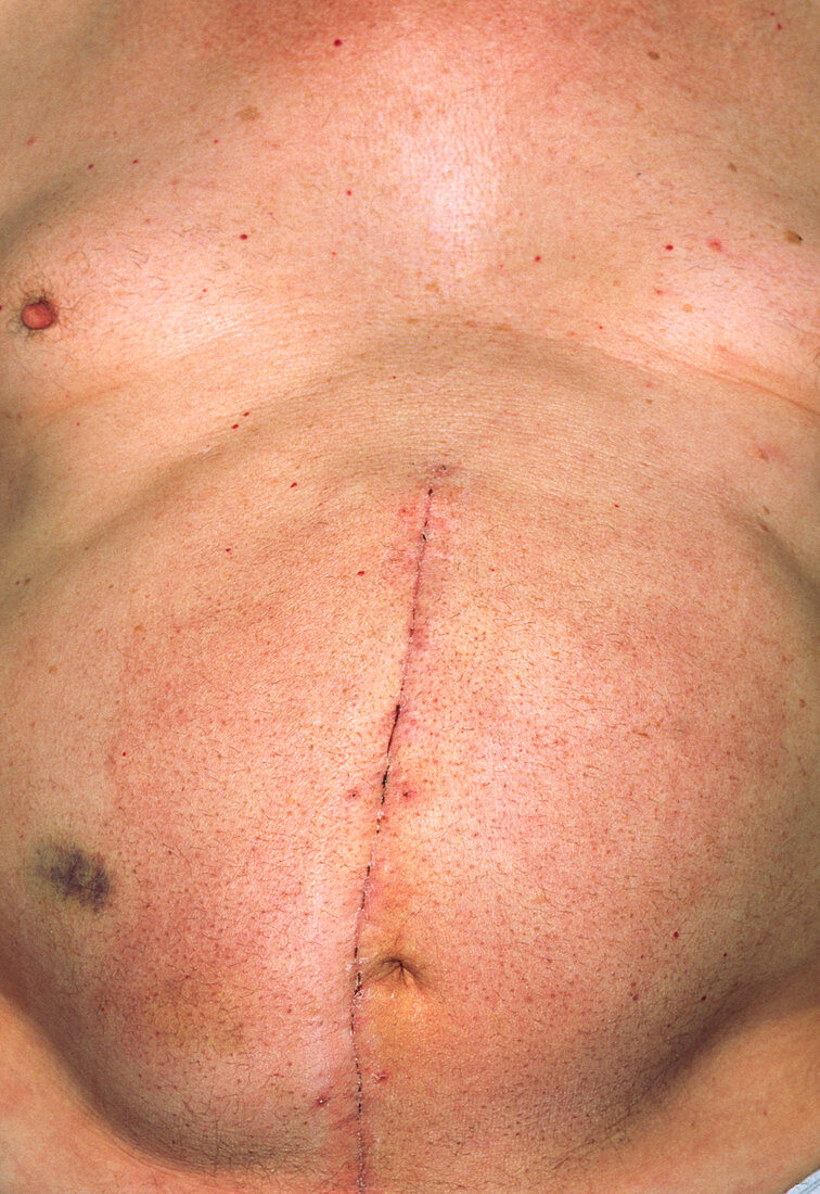 Close-up of abdomen scar after aneurysm operation