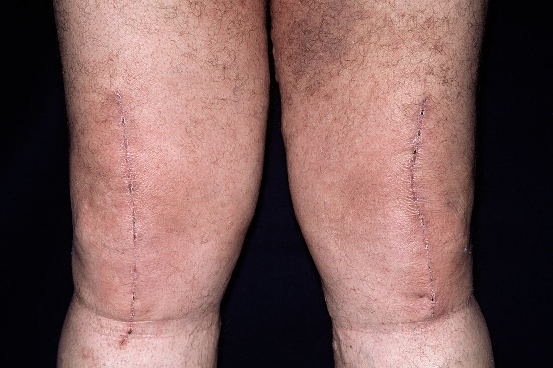 Knee surgery scars