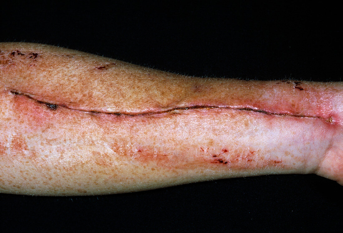 Vein removal scar