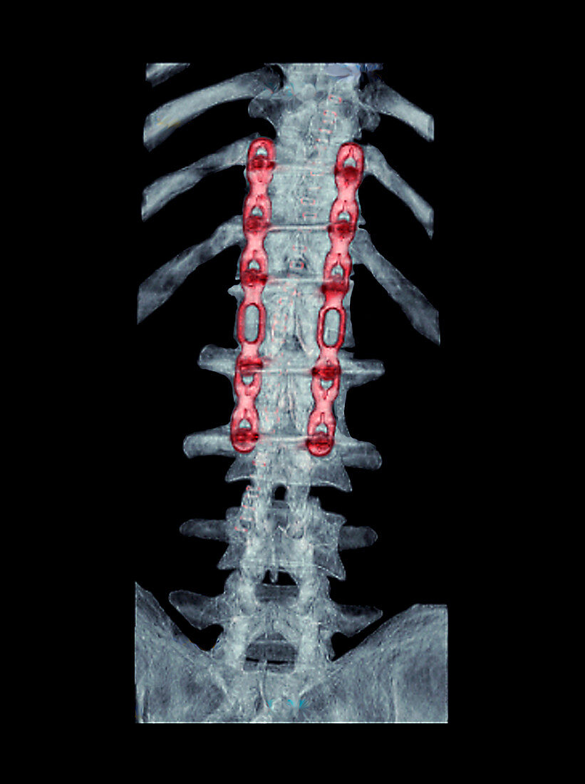 Pinned broken spine,3D CT scan
