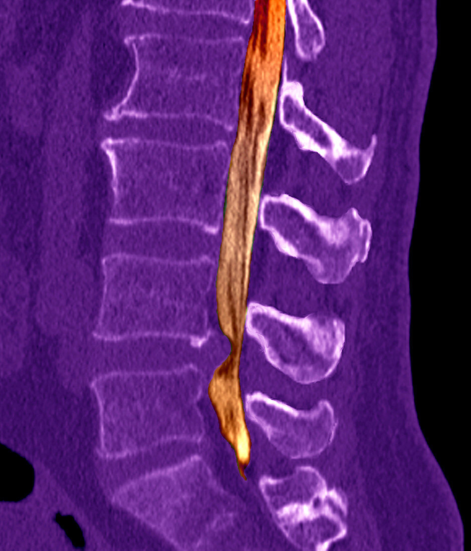Slipped disc,CT scan