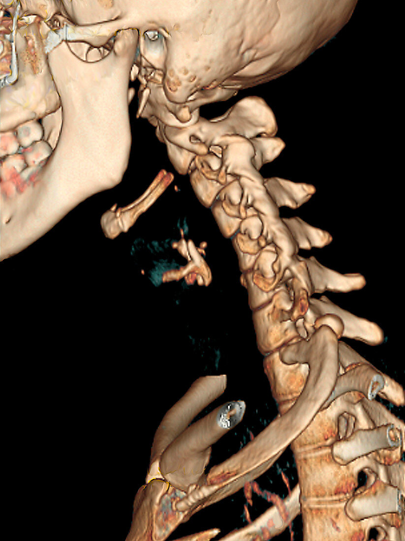 Straight cervical spine,CT scan