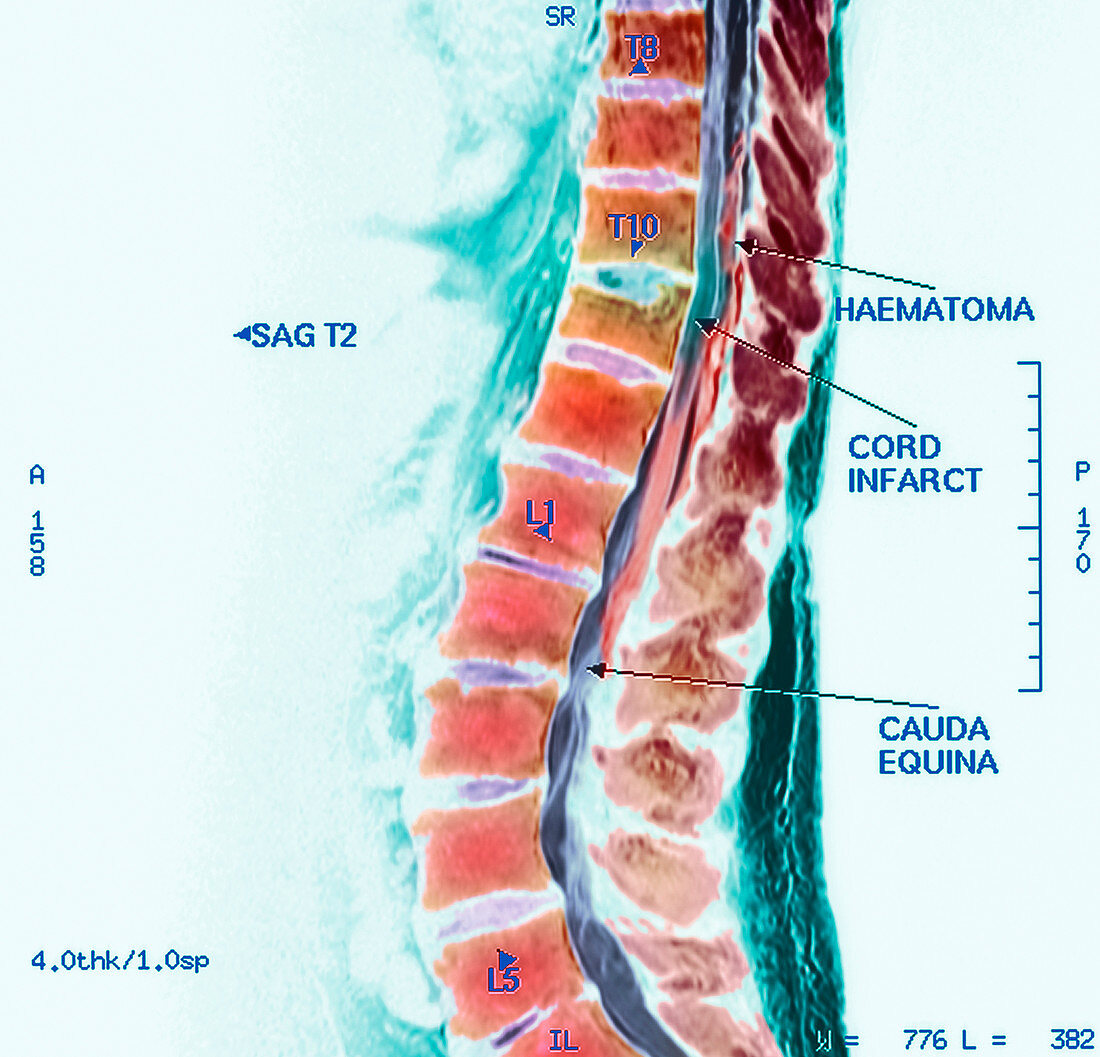 Spinal cord stroke,MRI scan