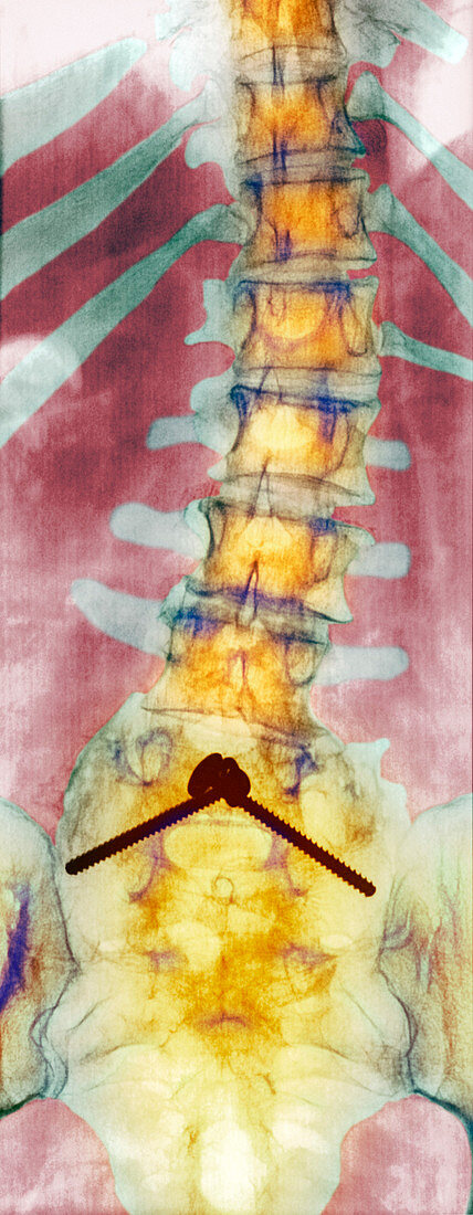 Pinned curved spine,X-ray