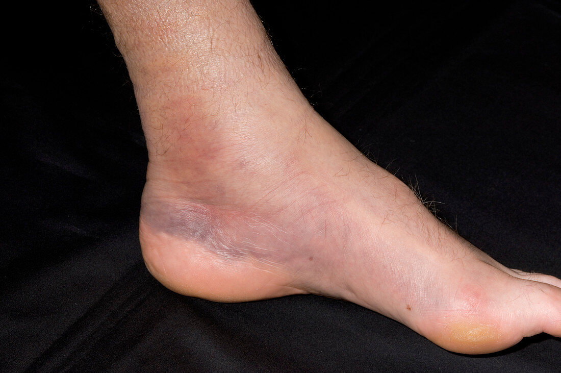 Bruised ankle