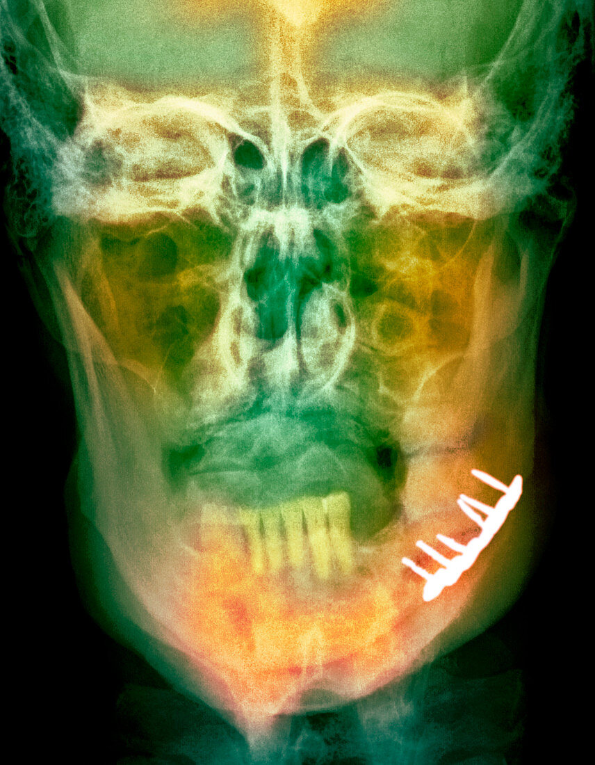 Pinned broken jaw,X-ray