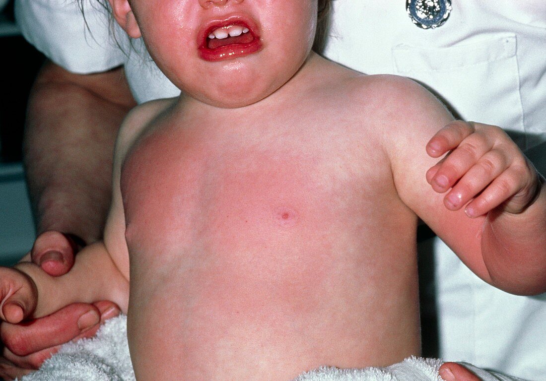 Hot water burns on an infant's chest