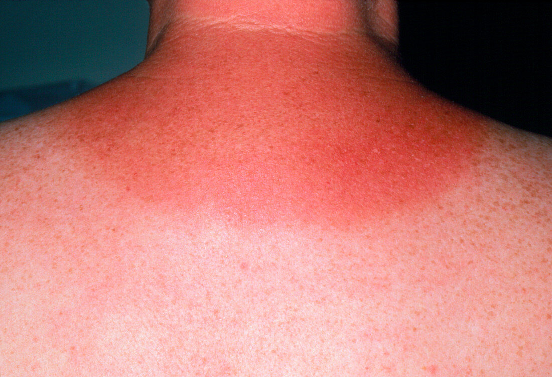 Sunburnt neck due to overexposure to sun