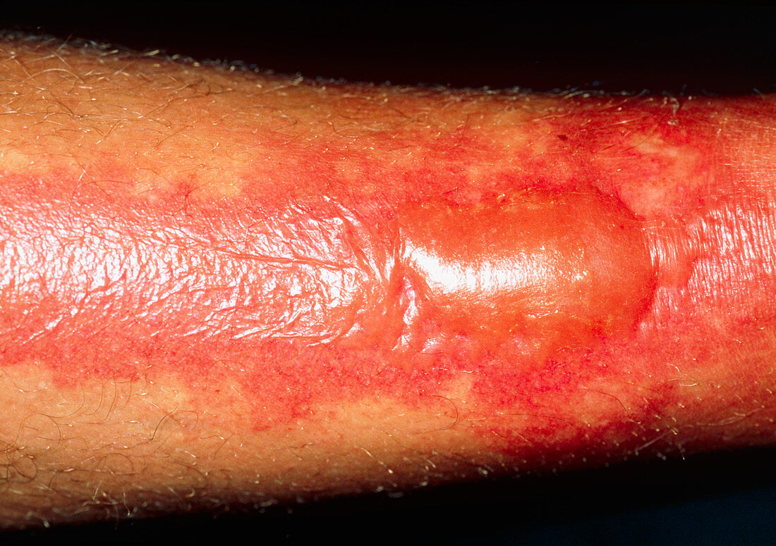 Extensive second degree burns on a man's leg