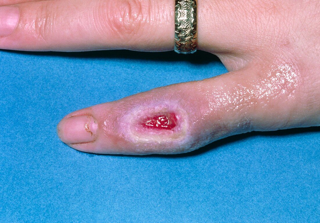 Localised third degree burn on woman's finger