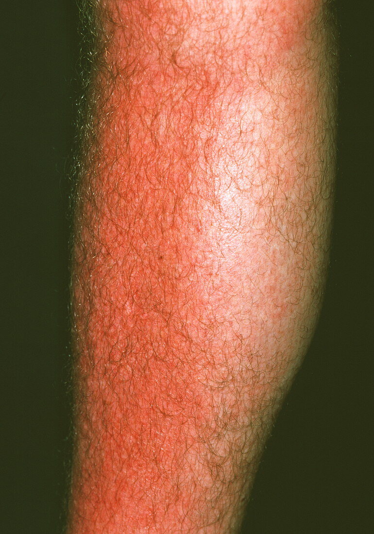 Sunburnt shin