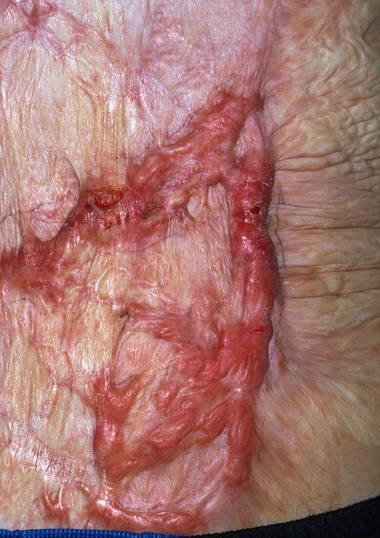 Skin graft scars