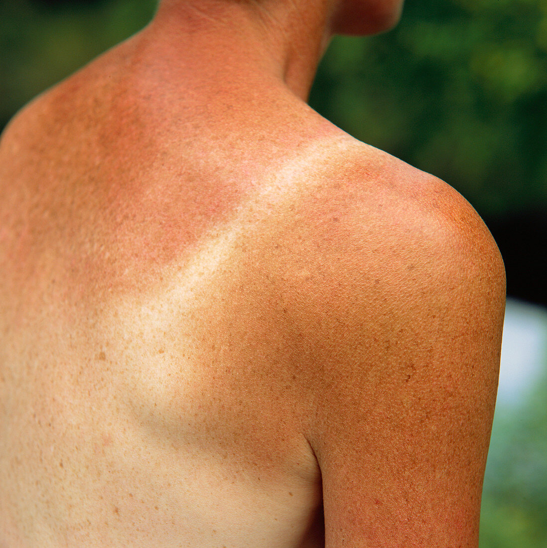 Sunburnt skin