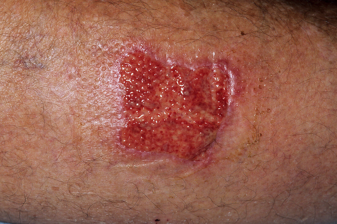 Infected burn