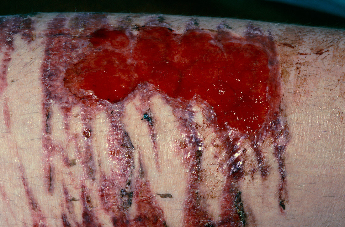 Infected skin graft donor site on 18-year-old man