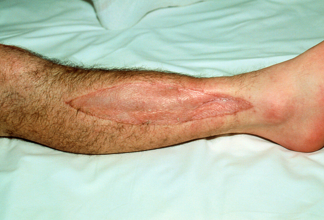 Healing skin graft on patient's leg