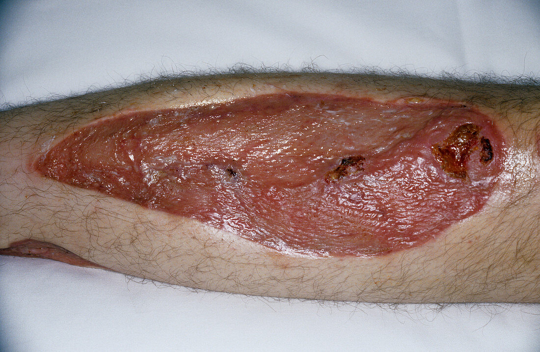 Leg skin graft