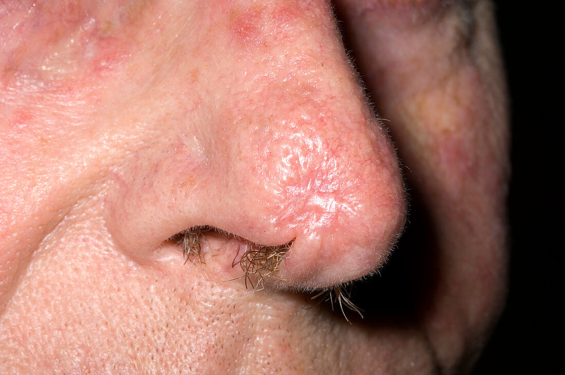 Nasal skin graft