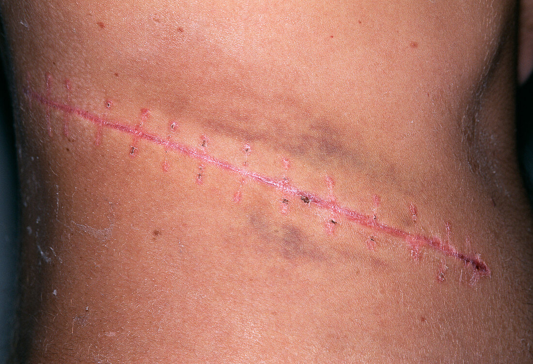 Laparotomy scar