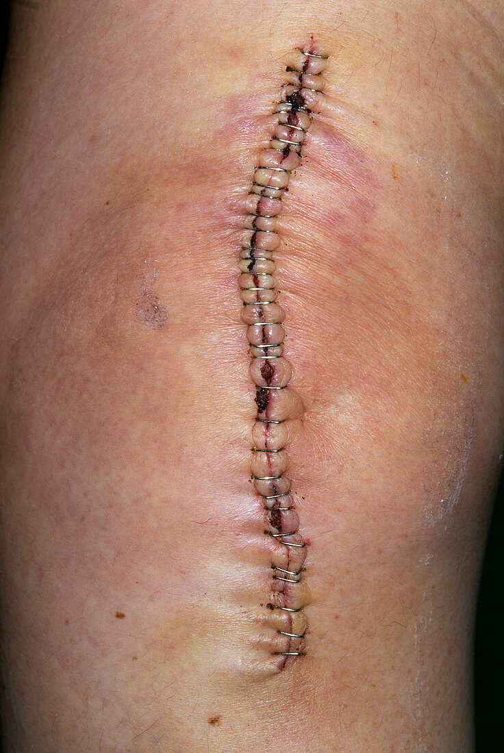 Knee replacement scar