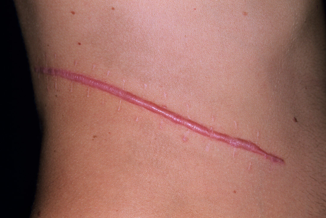 Keloid scar