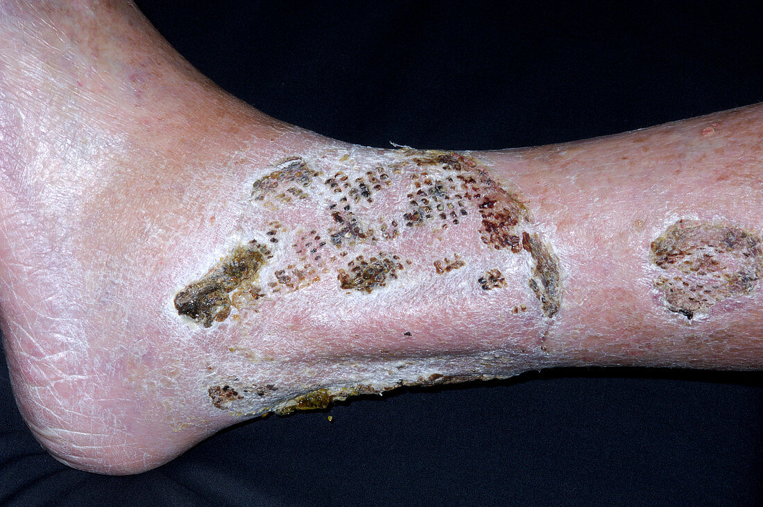 Scar after pyoderma ulcer treatment