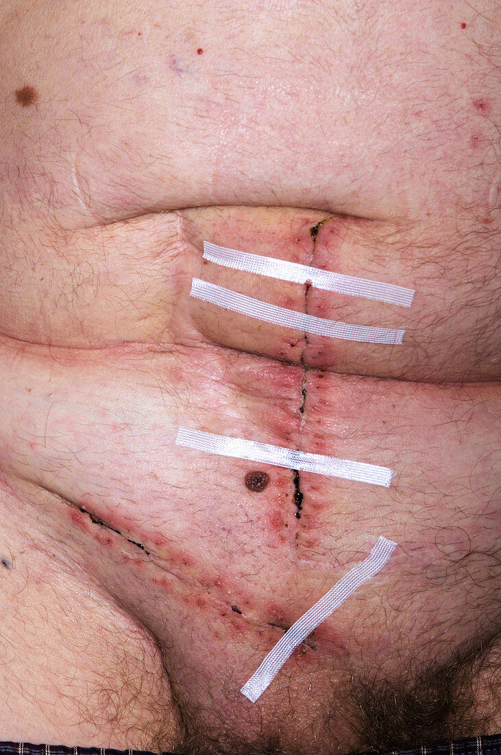 Hernia repair scar