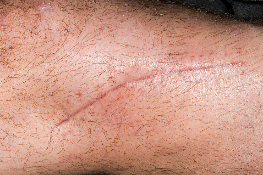 Scar on a fractured leg
