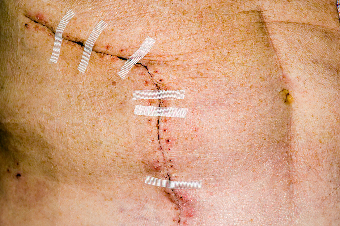 Surgical scar