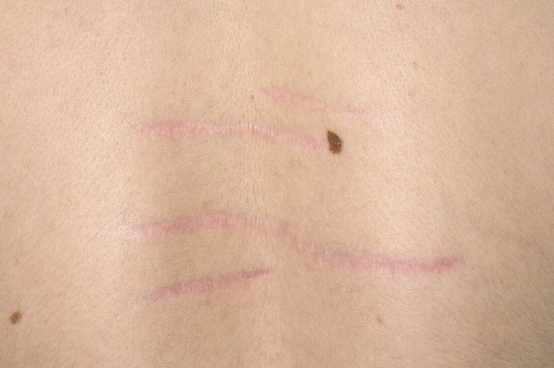Stud mark scars on back