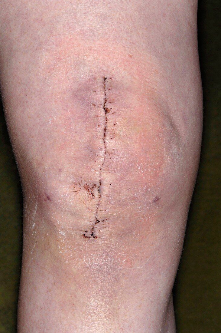 Knee repair surgery scar
