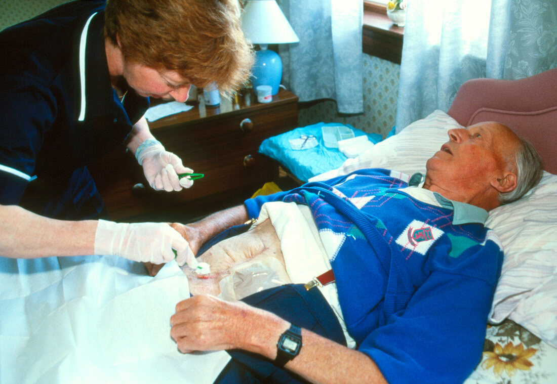 Nurse dressing stoma of elderly colostomy patient