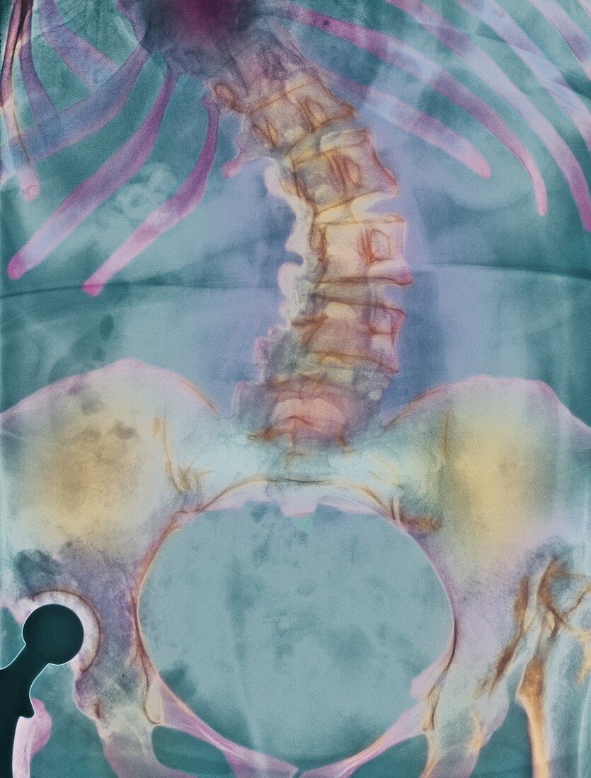 Scoliosis spine deformity,X-ray