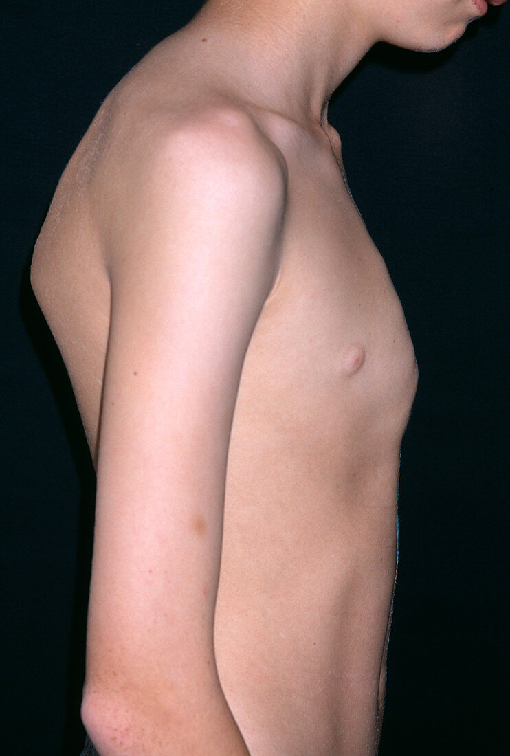 Pigeon chest deformity