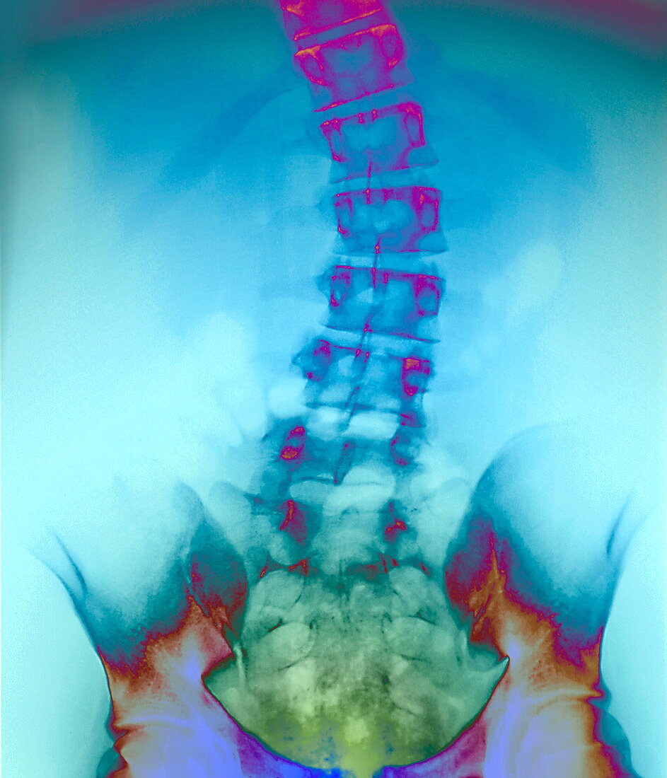Scoliosis,X-ray