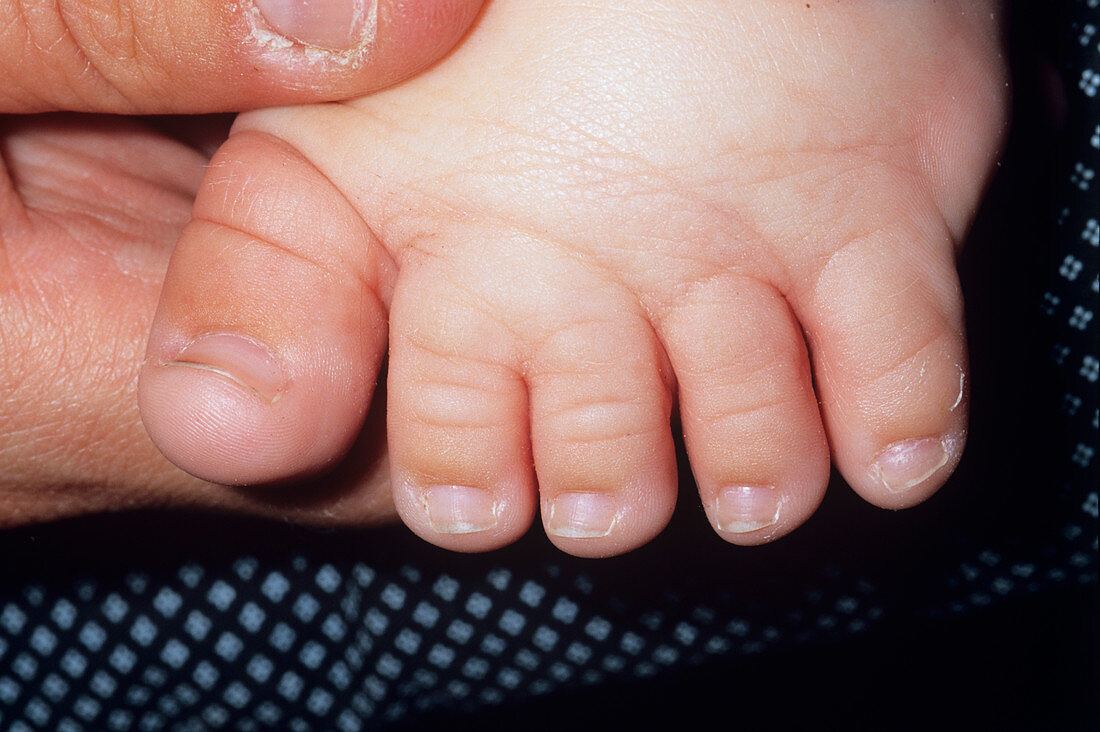 Webbed toes