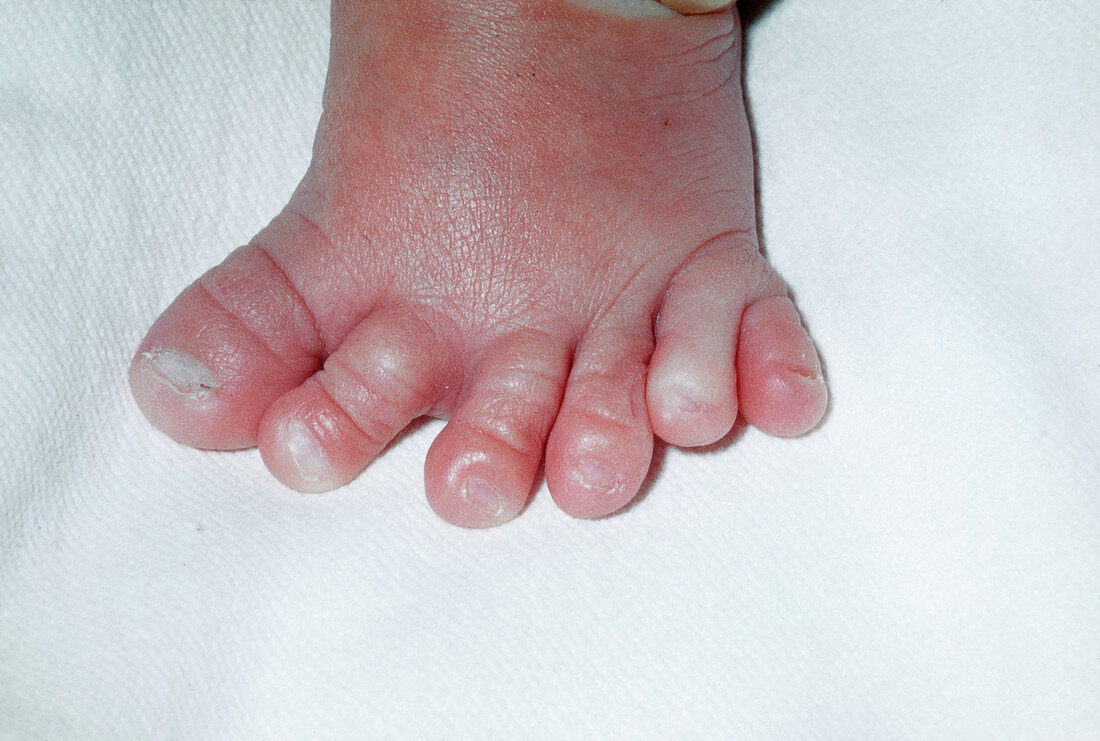 Polydactyly: a six-toed foot