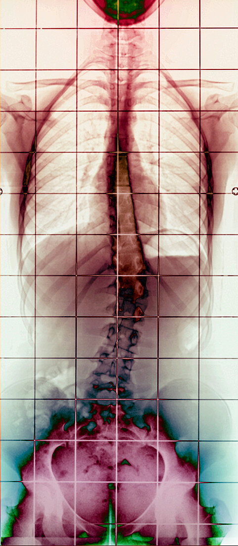 Scoliosis,X-ray