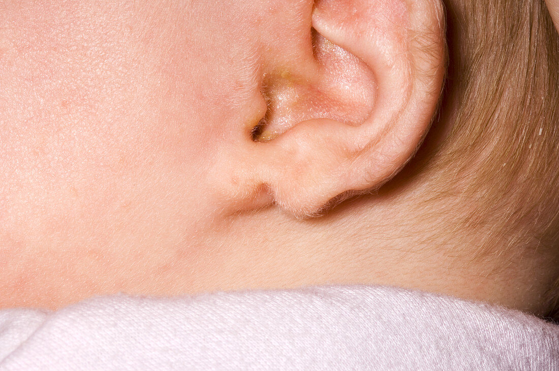 Congenital split ear lobe